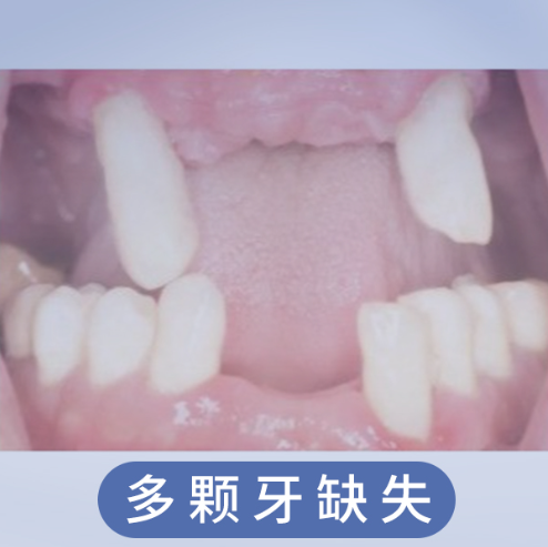 多颗牙缺失