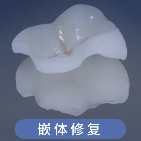微创嵌体修复